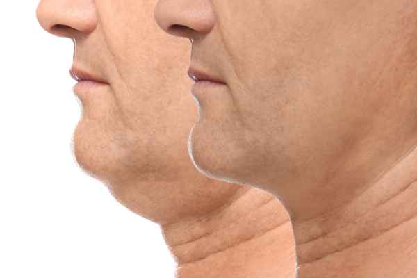 HIFU - Breakthrough in Anti - ageing 2 hifu results Newark-on-Trent